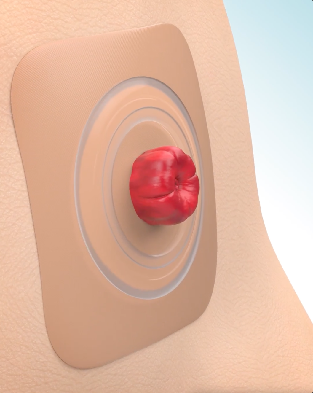 演示 Convatec 膠粘劑工作原理的視頻