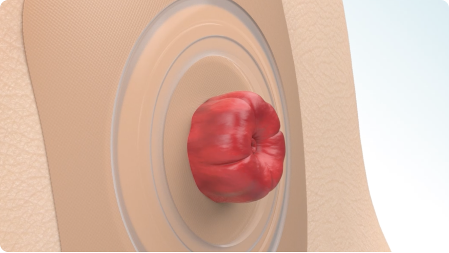 a drawing of a stoma