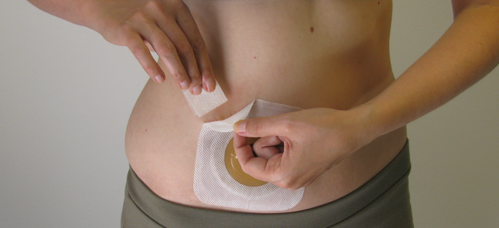 ConvaTec Esteem Synergy Versorgungswechsel Schritt f&uuml;r Schritt 16