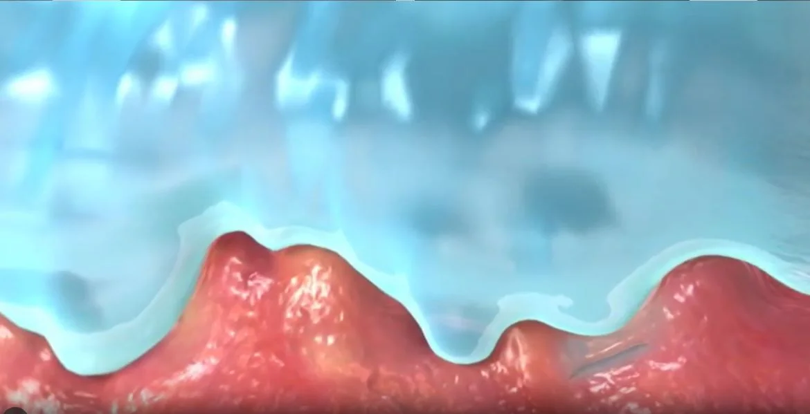drawing of Micro-Contours to Wound Bed