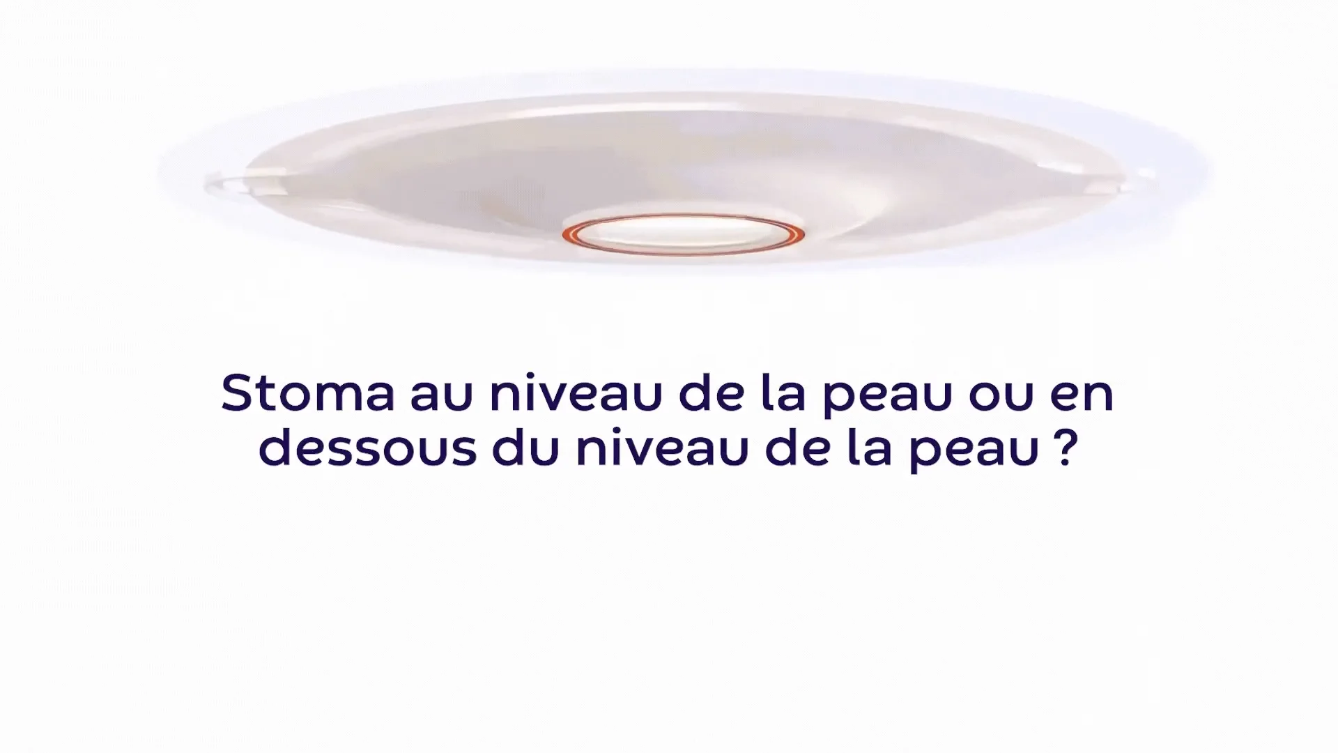 Plaque de protection cutanée pour stomie sur stomie rétractée